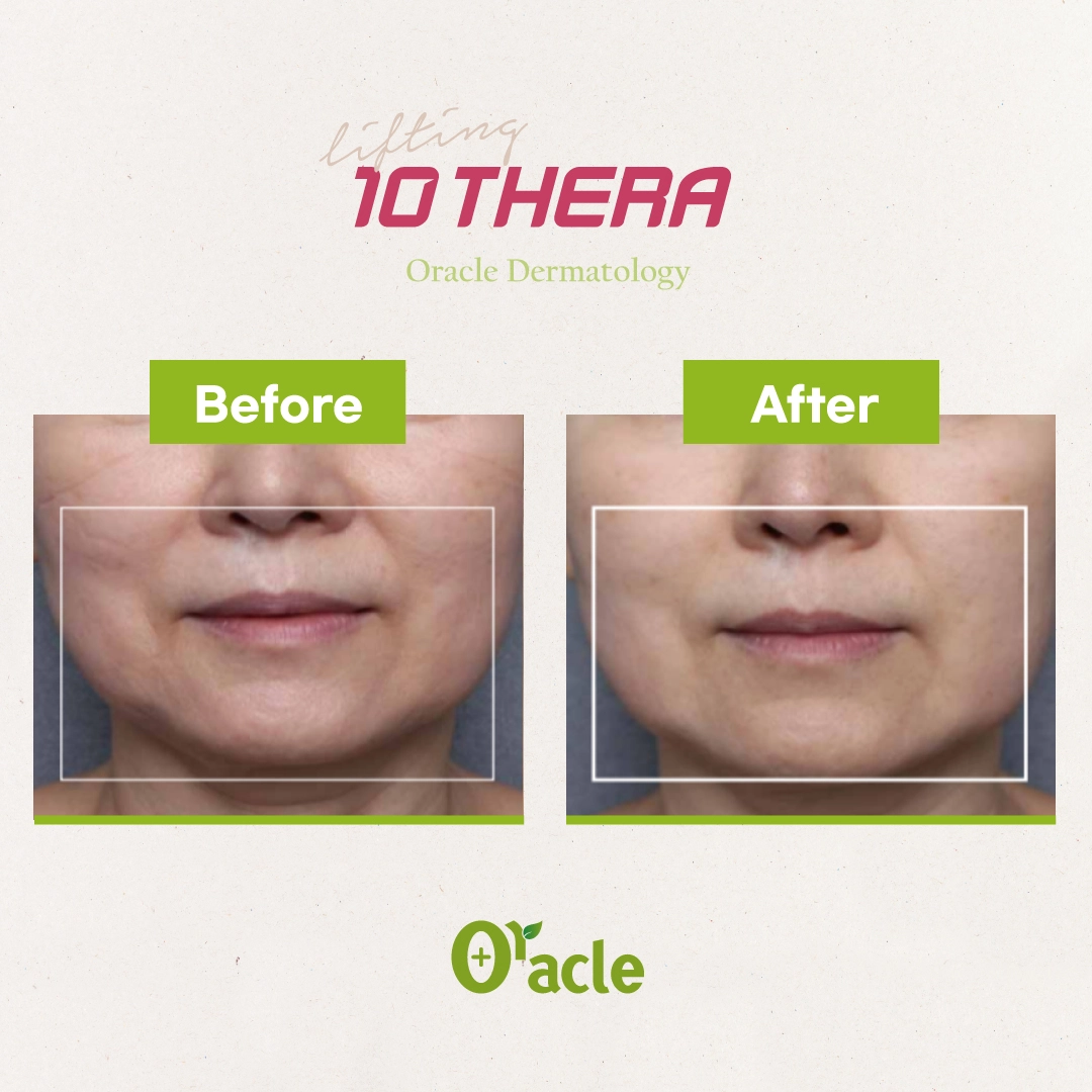 10Thera